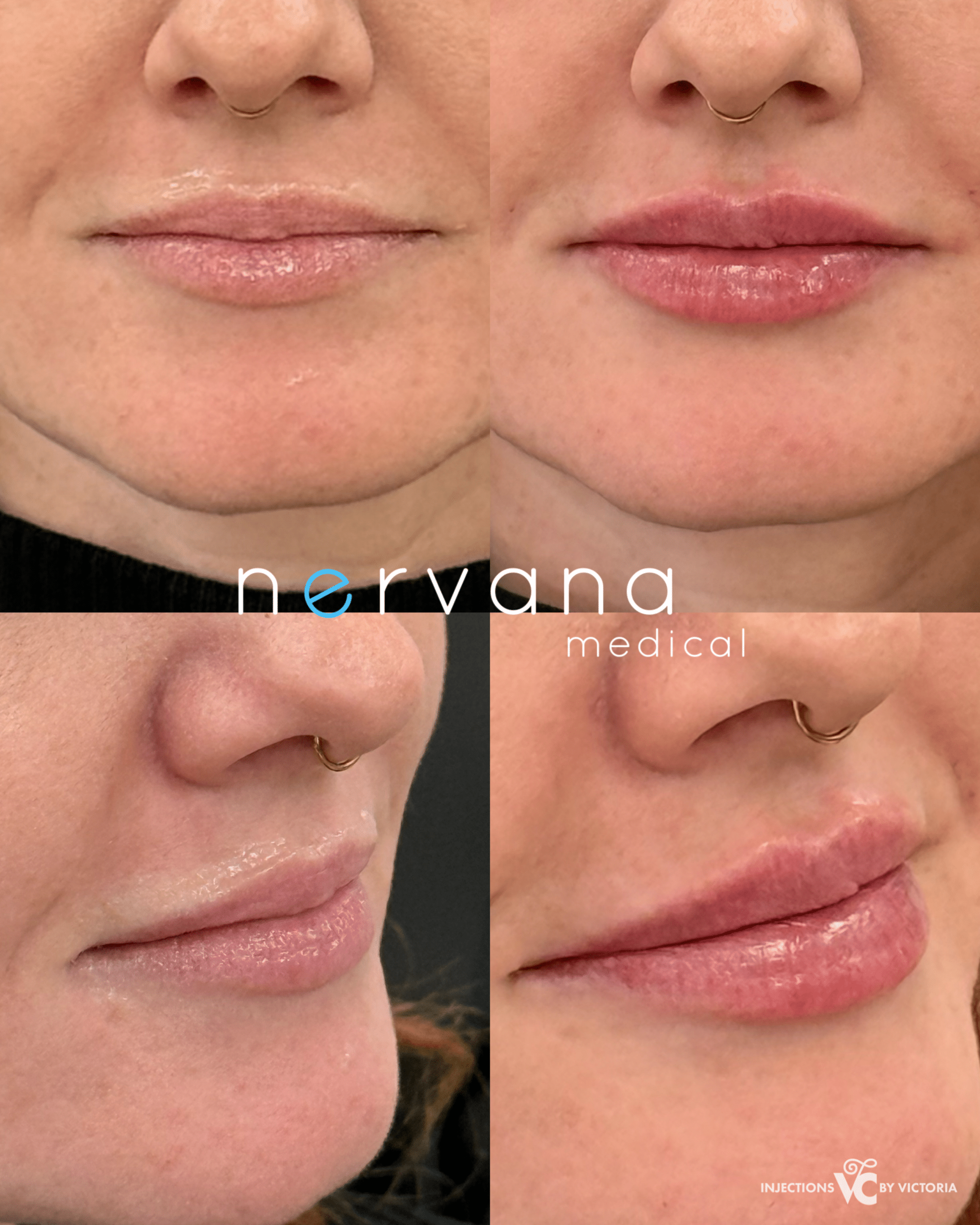 Before and After Image: Lip Injections - front