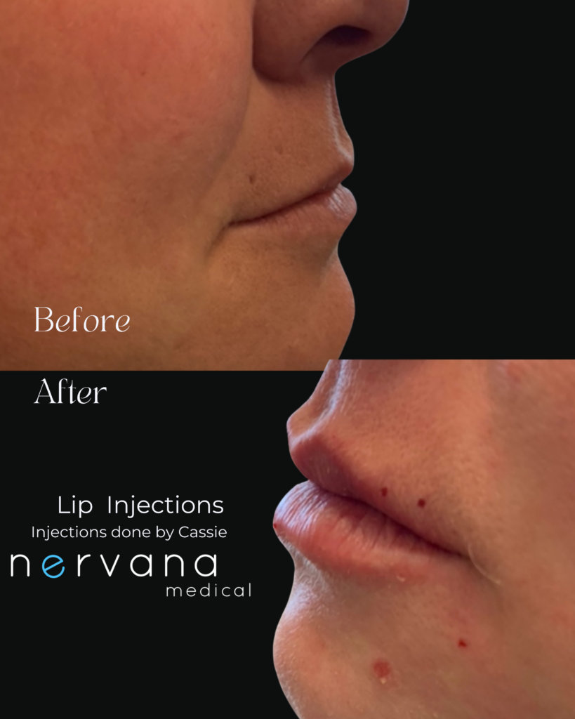 Before and After Image: Lip Injections - front