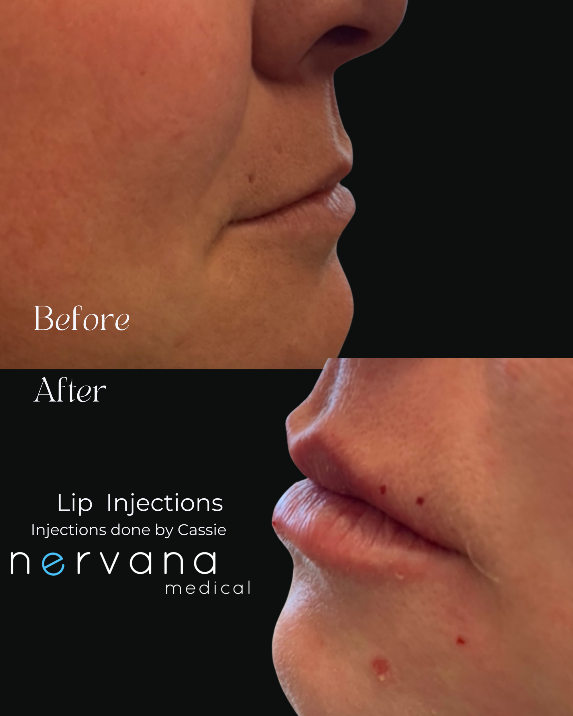 Before and After Image: Lip Injections - front