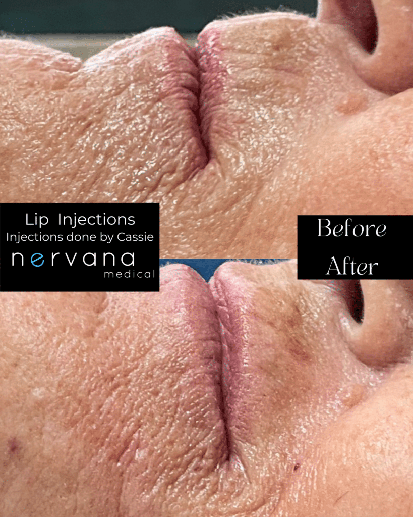 Before and After Image: Vertical Lip Lines “Smoker Lines/Straw Lines” - other