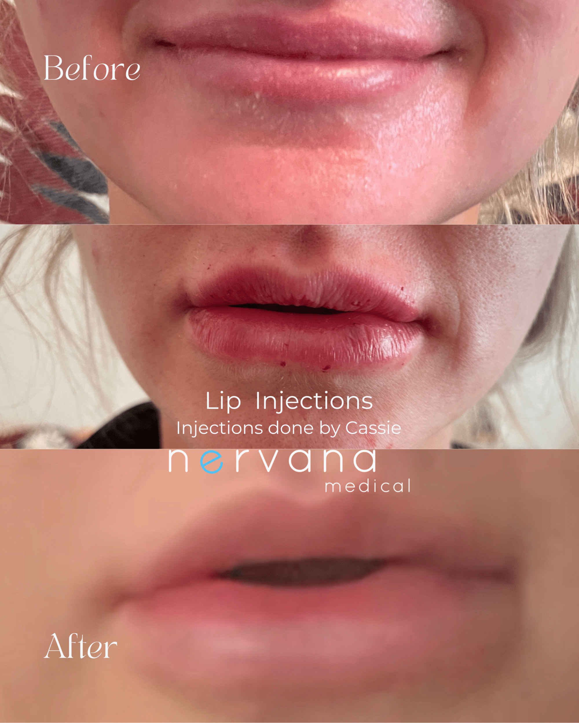 Before and After Image: Lip Injections - front