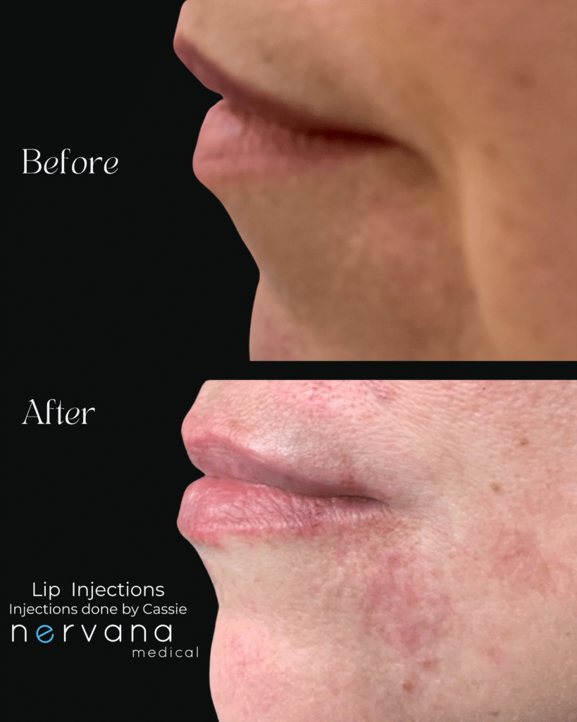 Before and After Image: Lip Injections + Marionette Lines - left-side