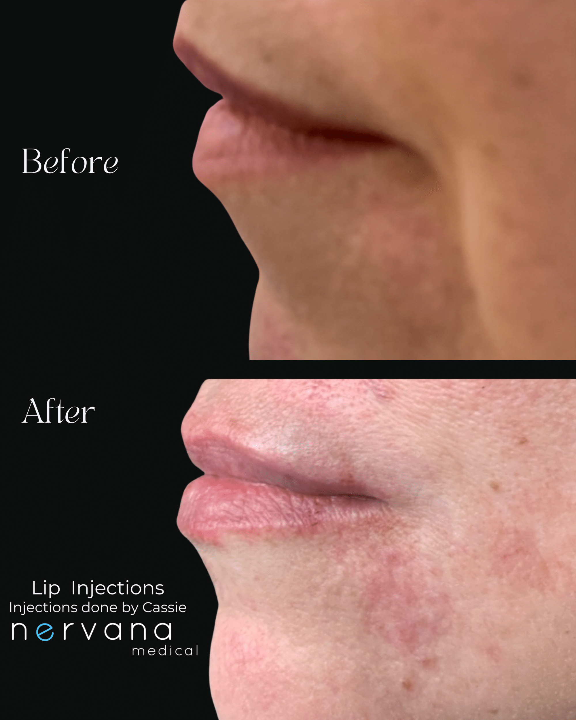 Before and After Image: Lip Injections - left-side