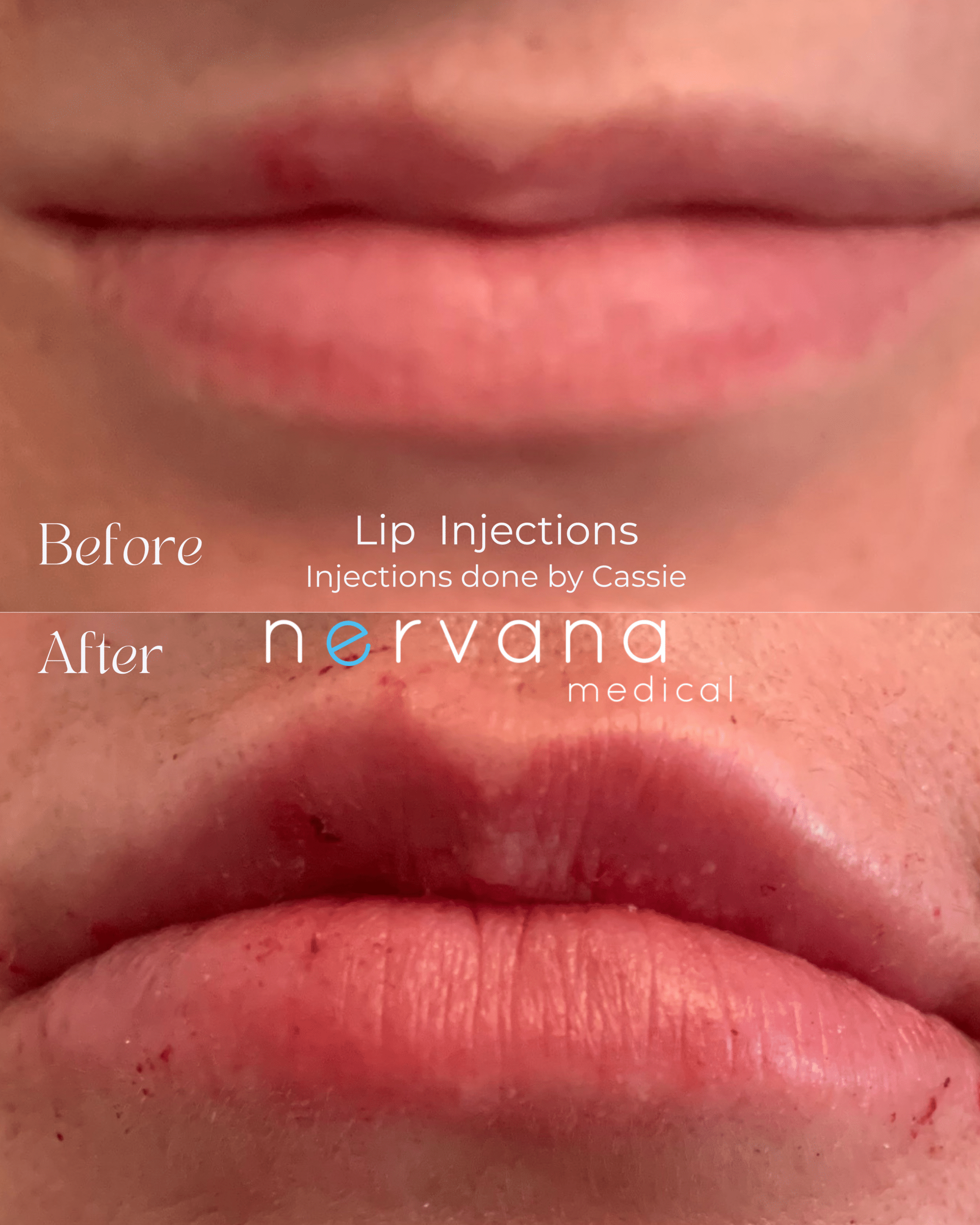 Before and After Image: Lip Injections - front