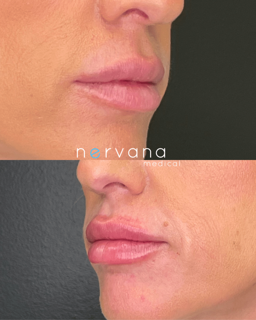Before and After Image: Lips Juv Ultra - right-front-oblique