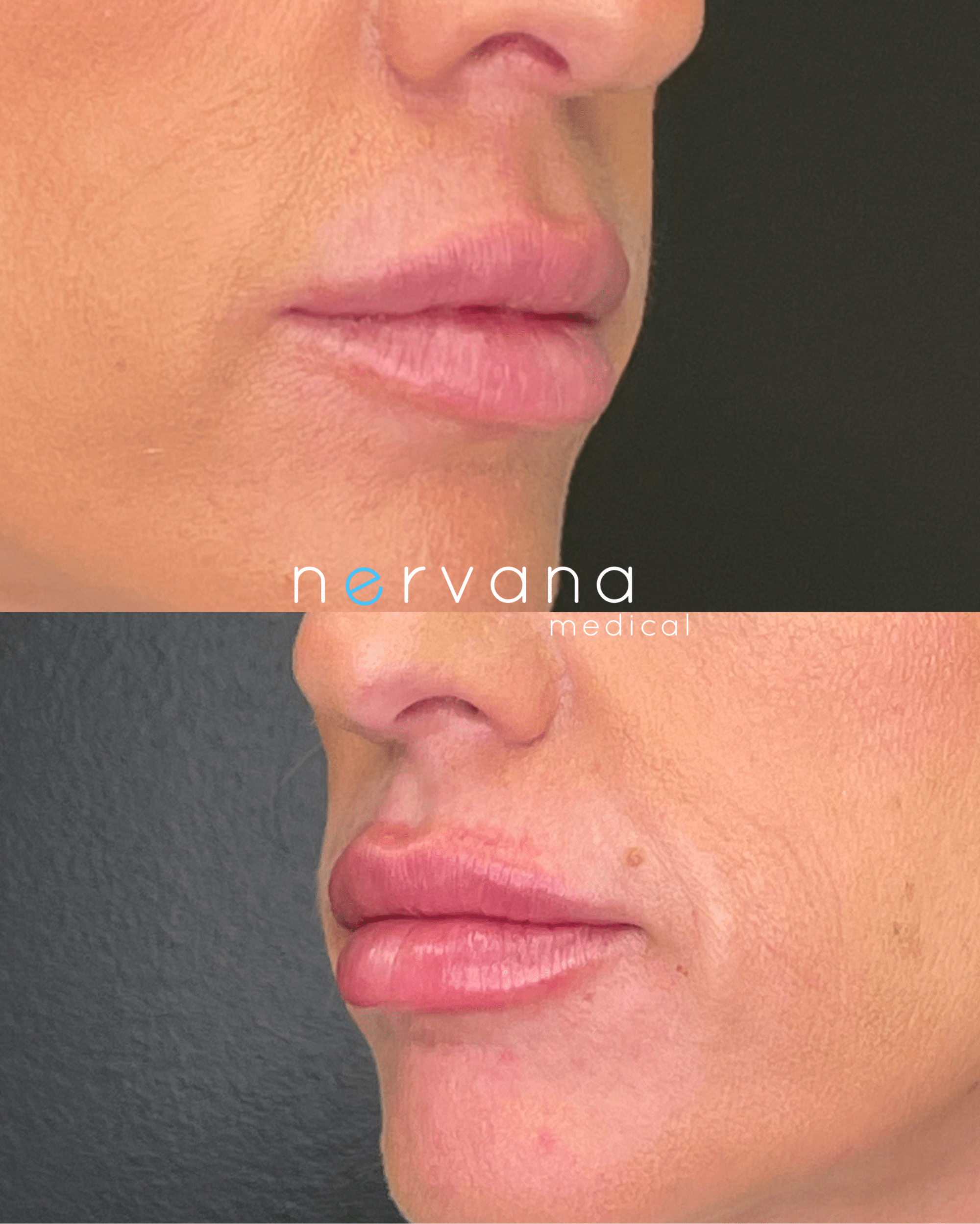 Before and After Image: Lips Juv Ultra - right-front-oblique