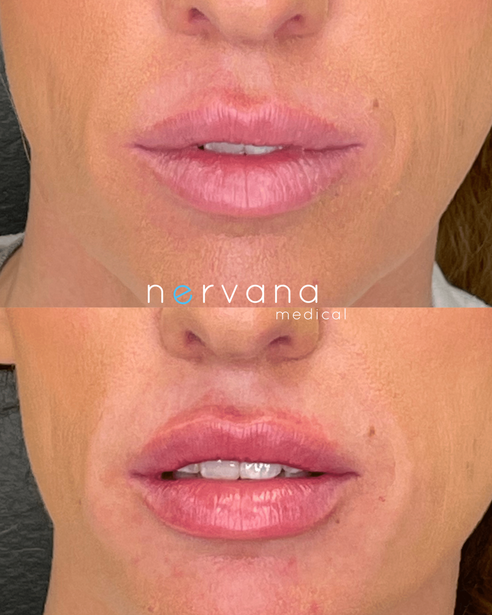 Before and After Image: Lips Juv Ultra - front