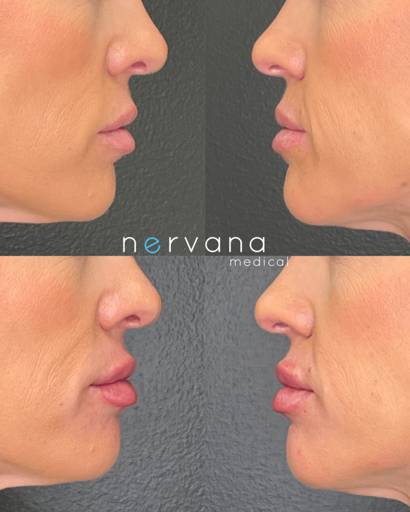Before and After Image: Lips Juv Ultra - front