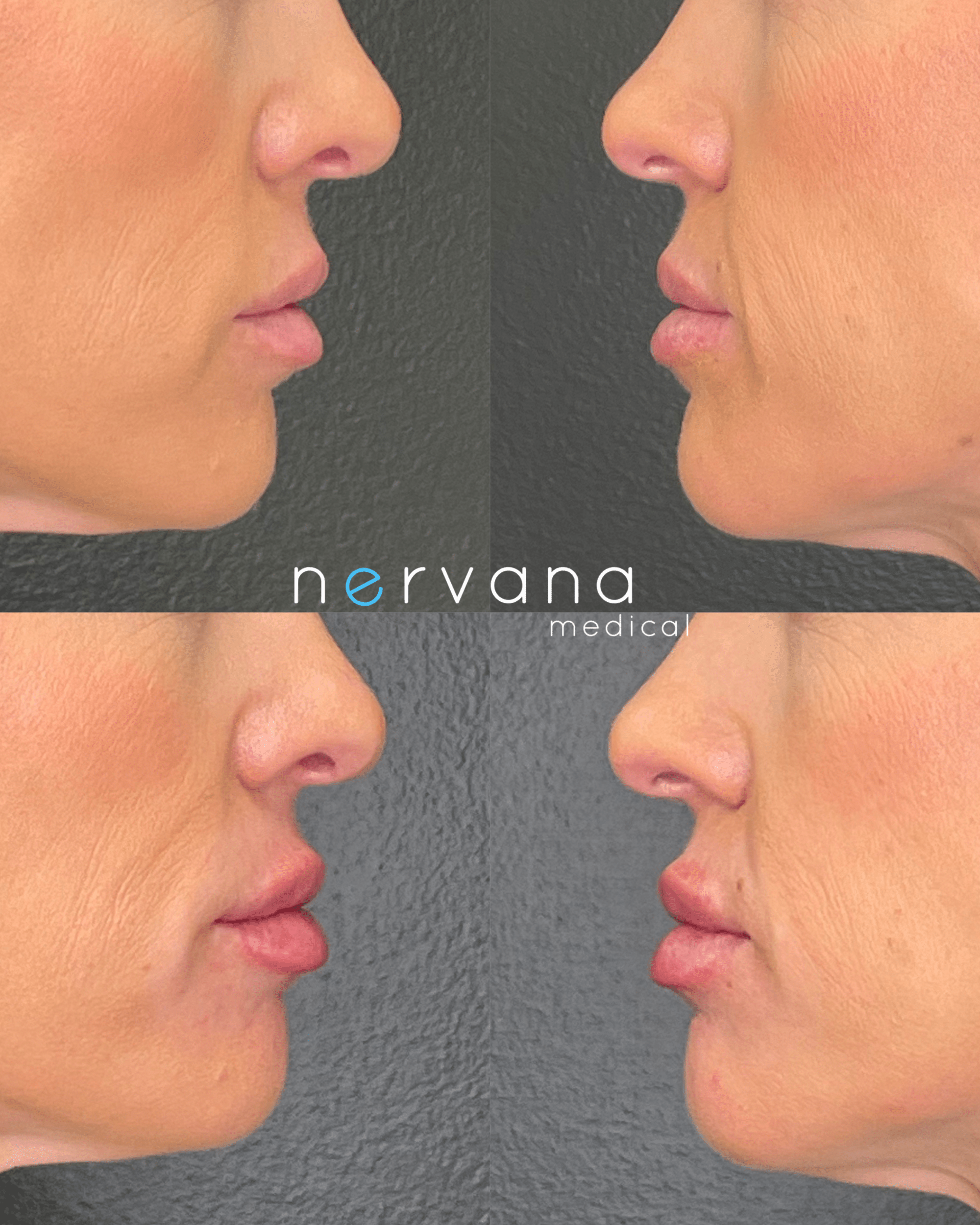 Before and After Image: Lips Juv Ultra - front