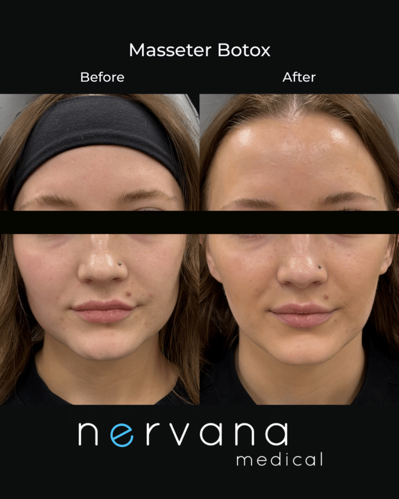 Before and After Image: Masseter Botox - front