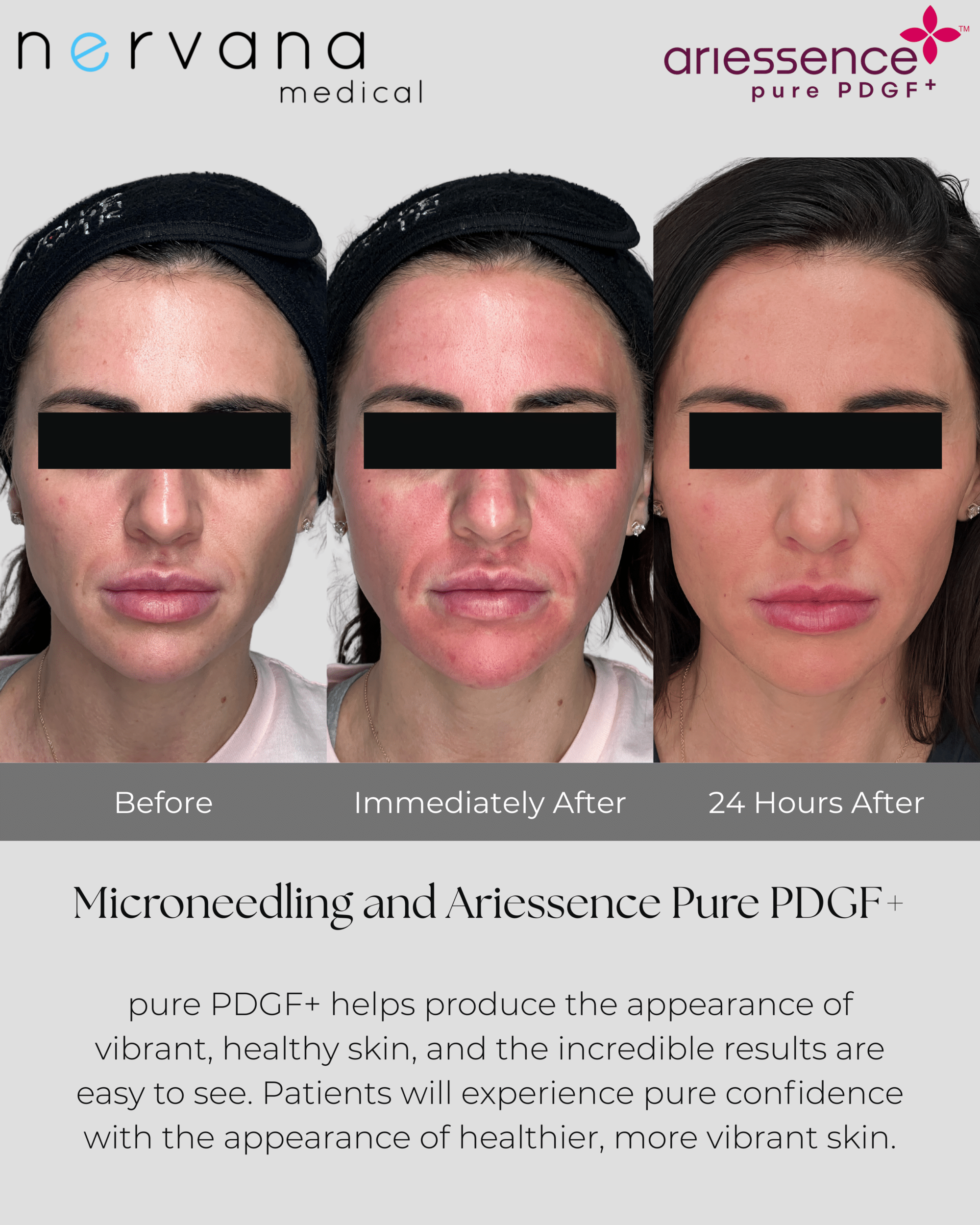 Before and After Image: Microneedling and Ariessence Pure PDGF+ - front
