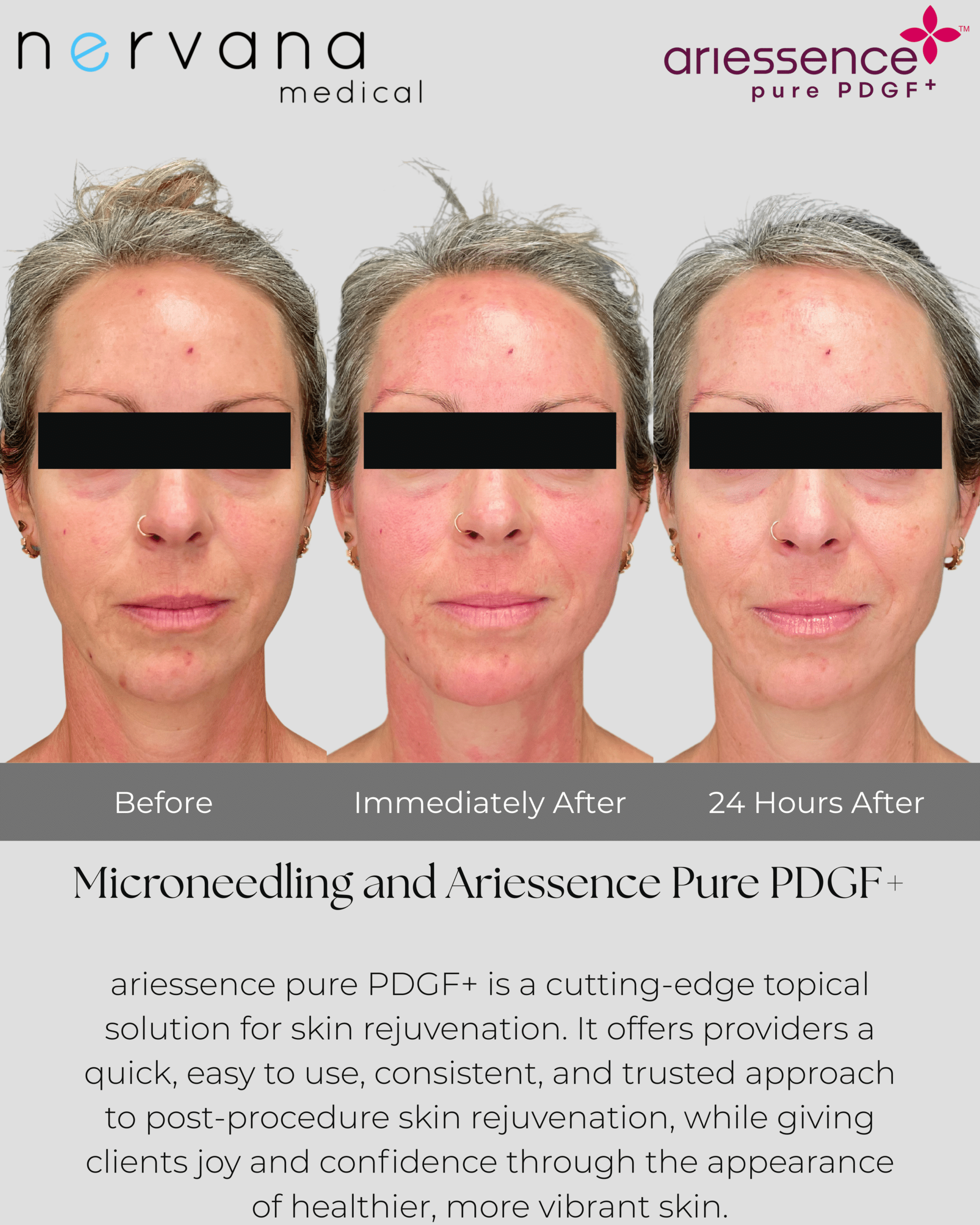 Before and After Image: Microneedling and Ariessence Pure PDGF+ - front