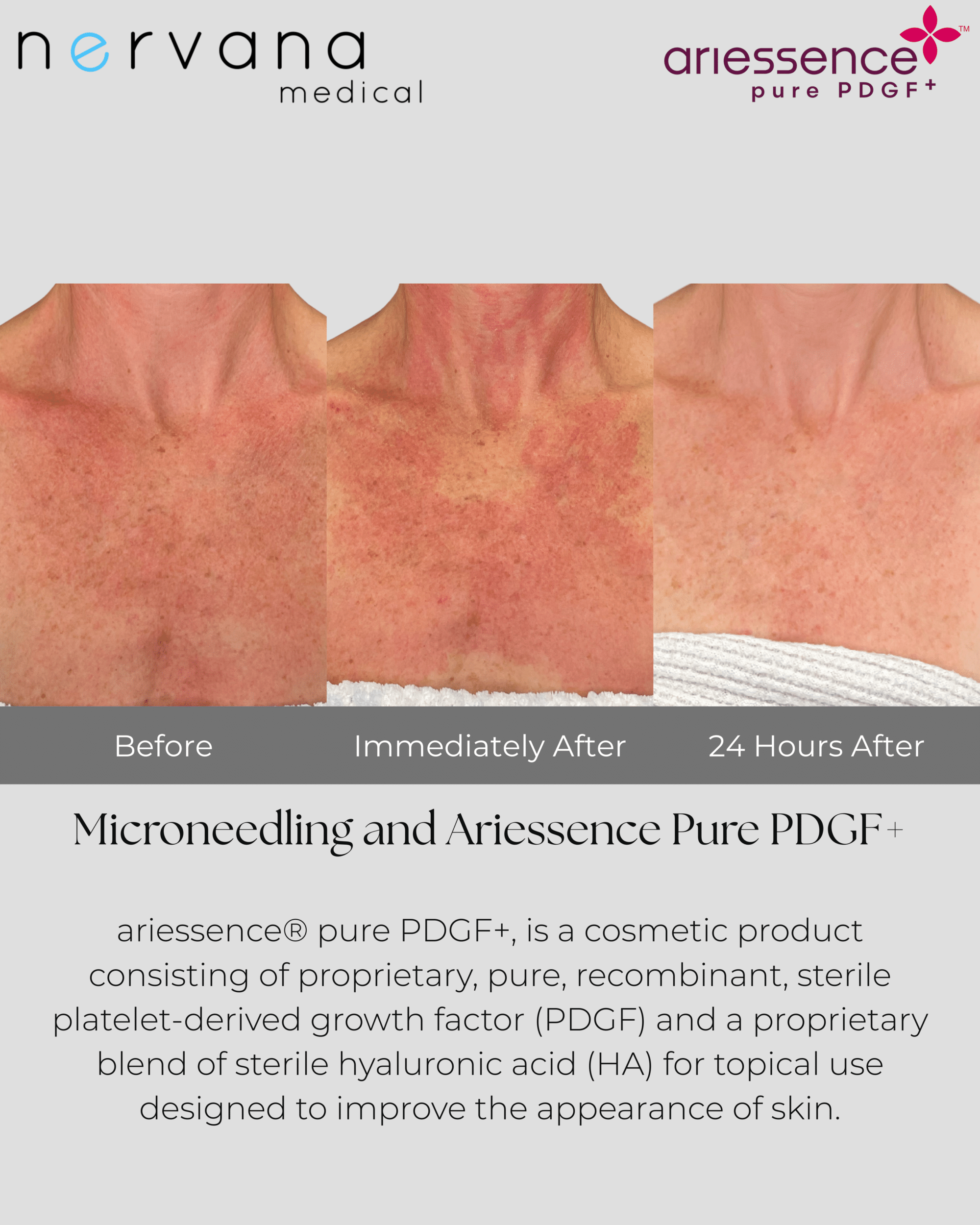 Before and After Image: Microneedling and Ariessence Pure PDGF+ - front