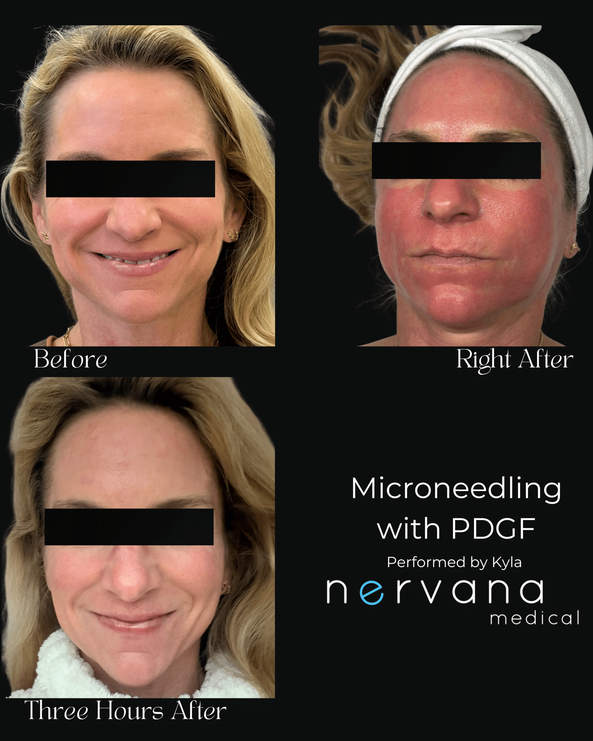 Before and After Image: Microneedling with PDGF - front