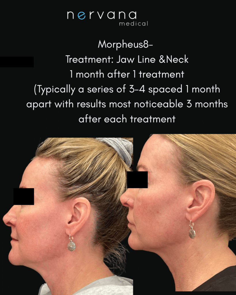 Before and After Image: Morpheus 8 (first treatment) - front