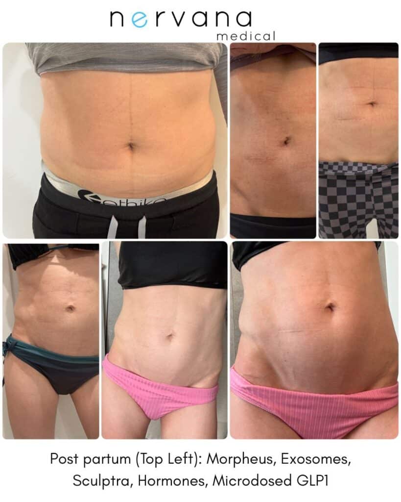 Morpheus - RF Microneedling in Sandy, UT