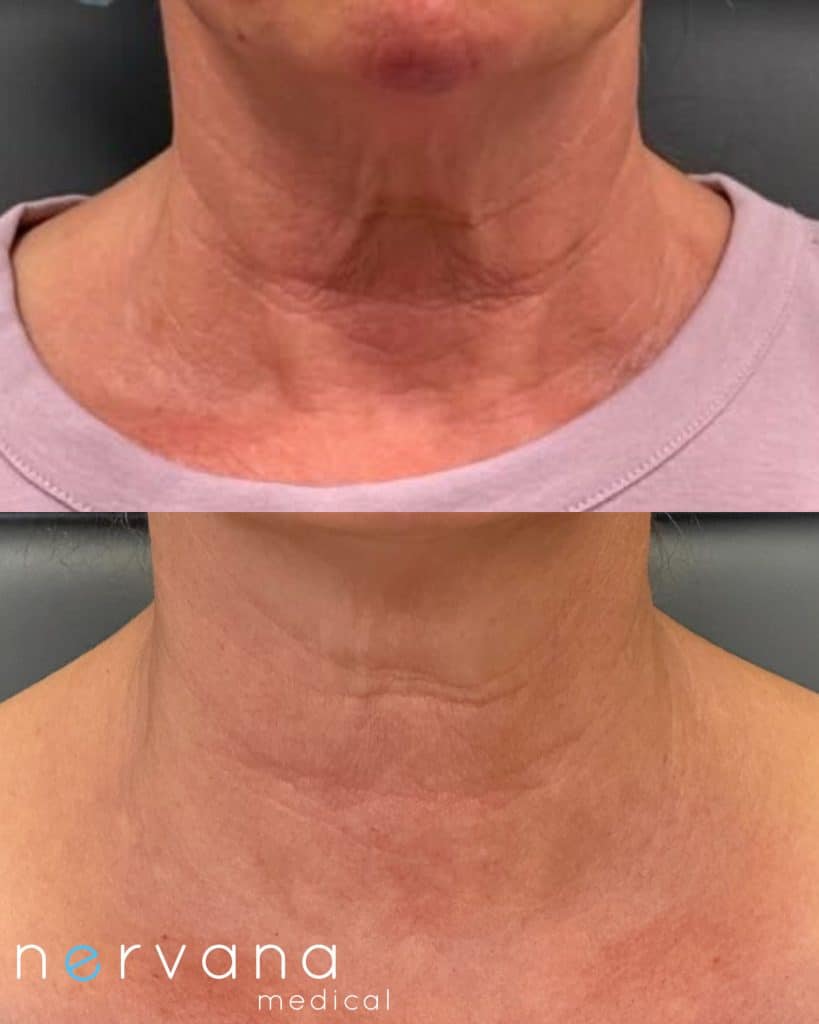Morpheus x Radiesse neck Morpheus - RF Microneedling in Sandy, UT