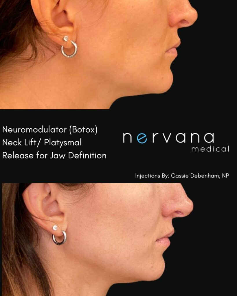 Botox/Dysport in Sandy, UT