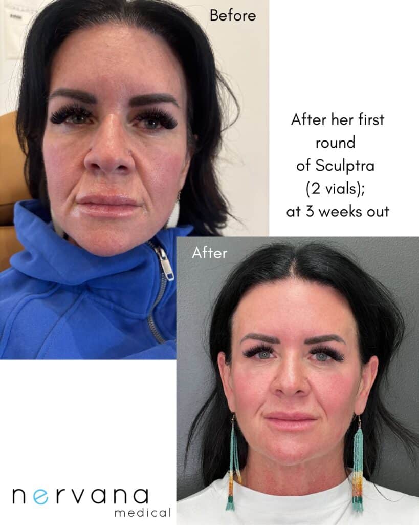 Before and After Image: Sculptra - front