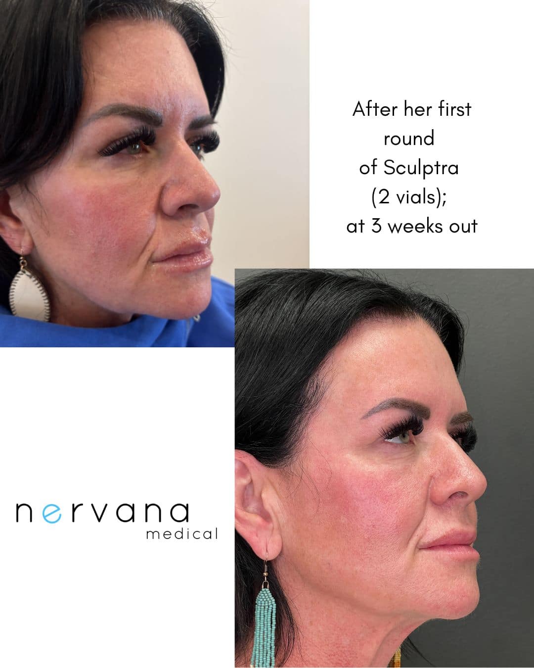 Before and After Image: Sculptra - right-front-oblique