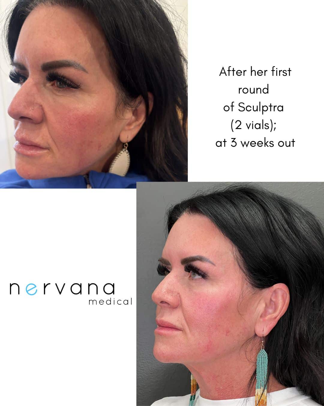 Before and After Image: Sculptra - left-front-oblique