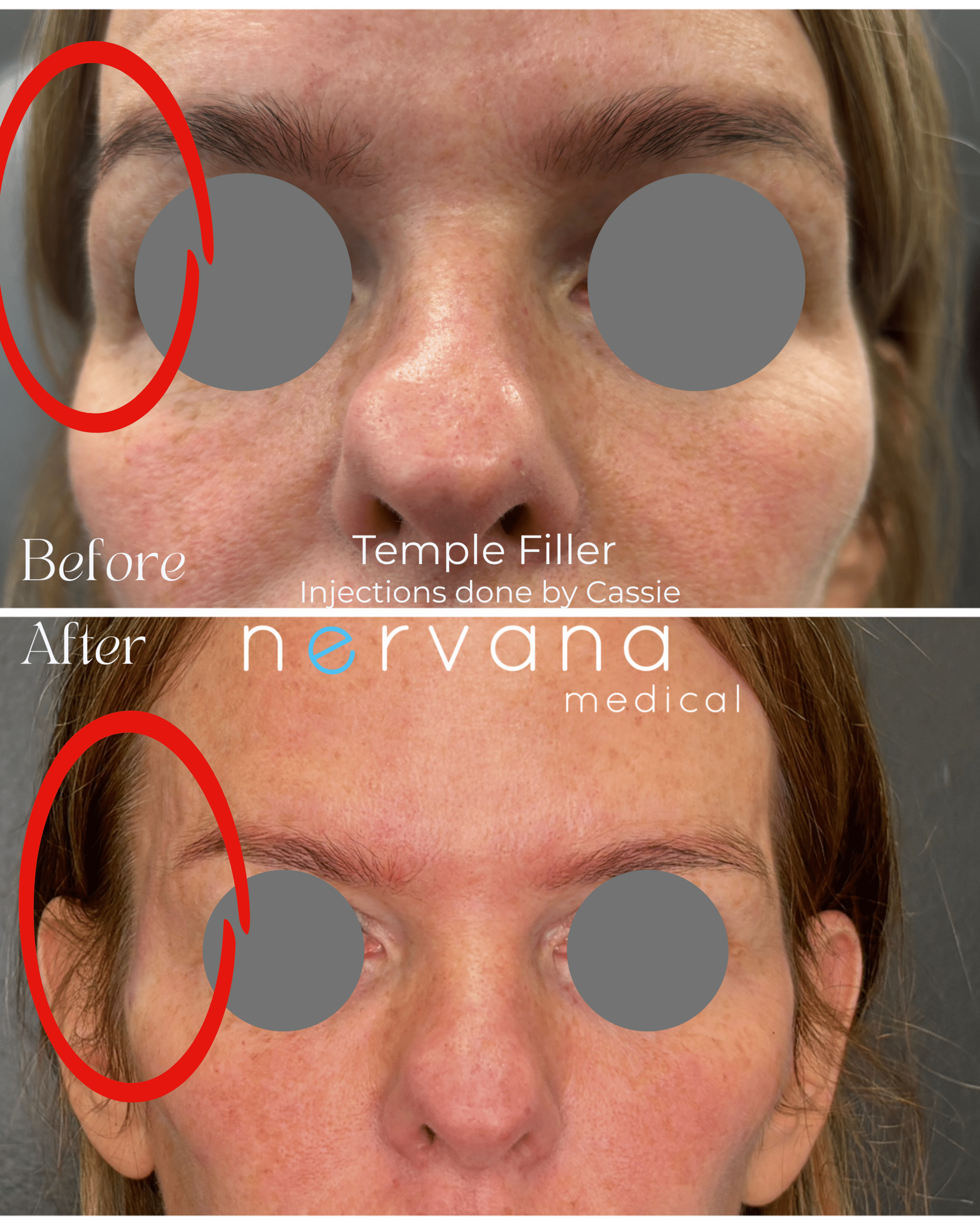 Before and After Image: Temple Filler - front