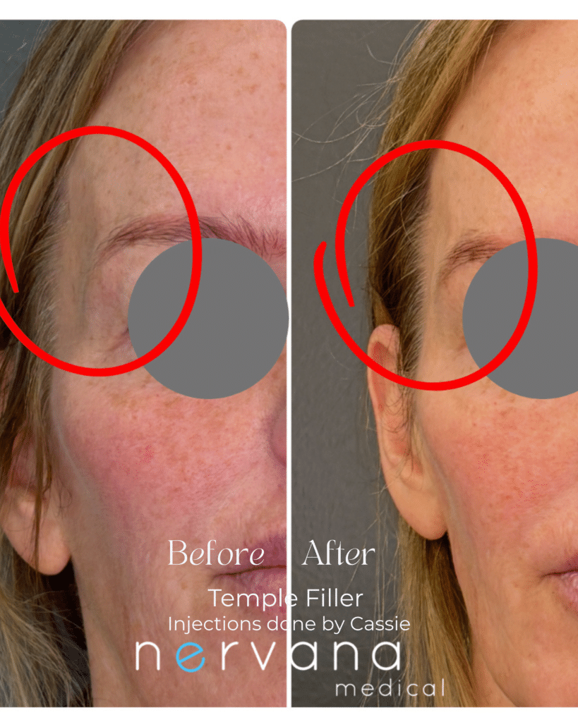 Before and After Image: Temple Filler - front