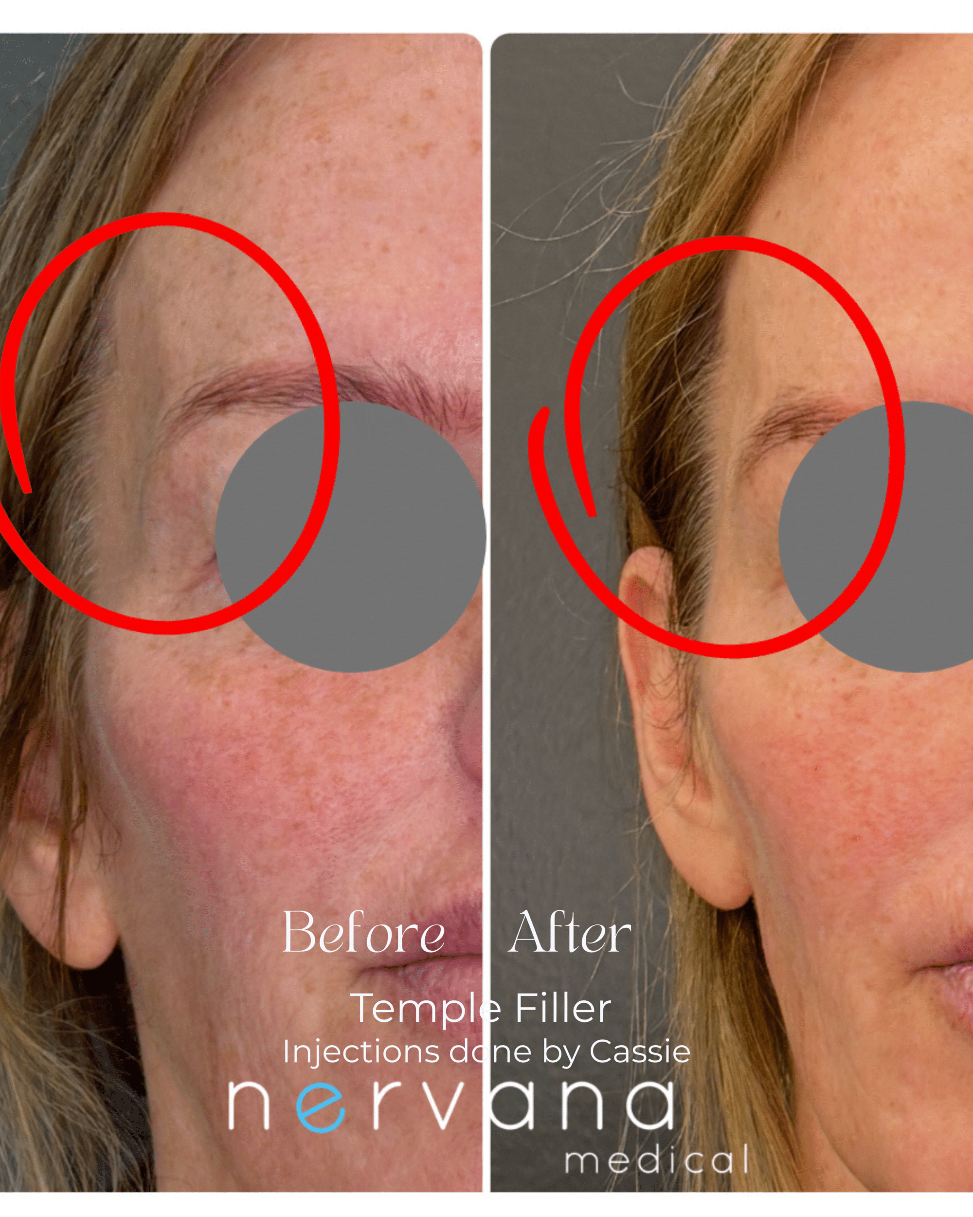 Before and After Image: Temple Filler - front