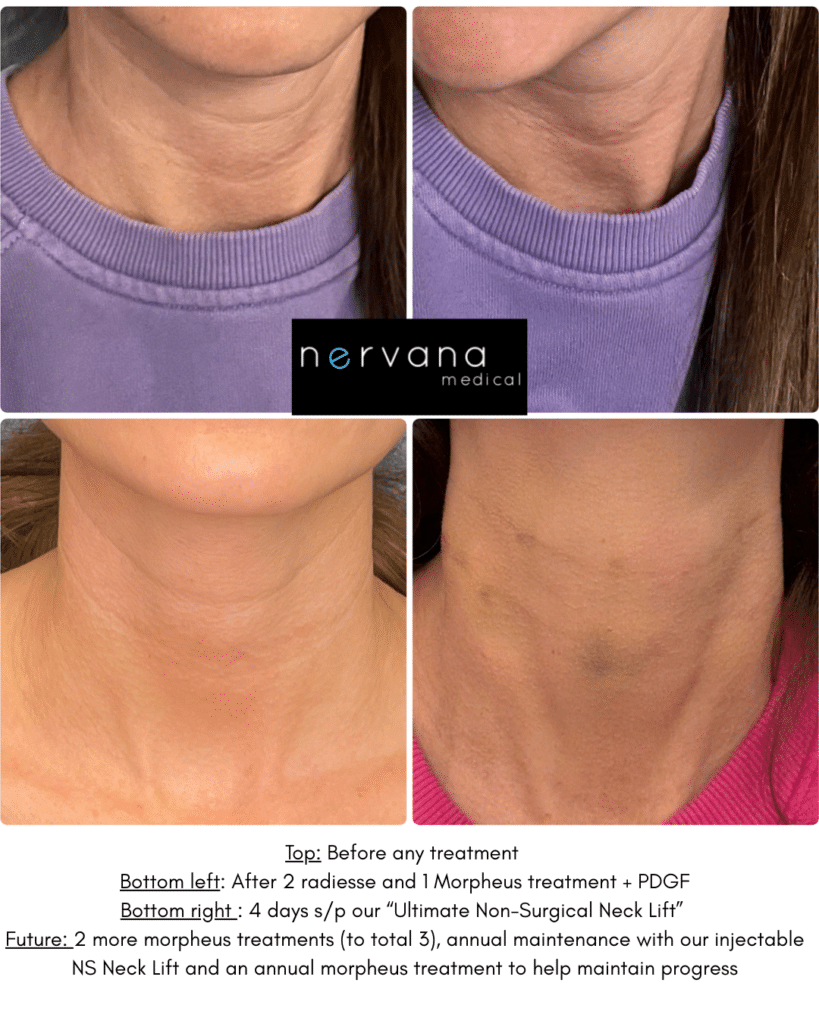 Before and After Image: Radiesse and Morpheus - front