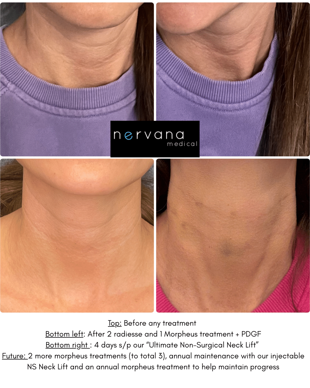 Before and After Image: Radiesse and Morpheus - front