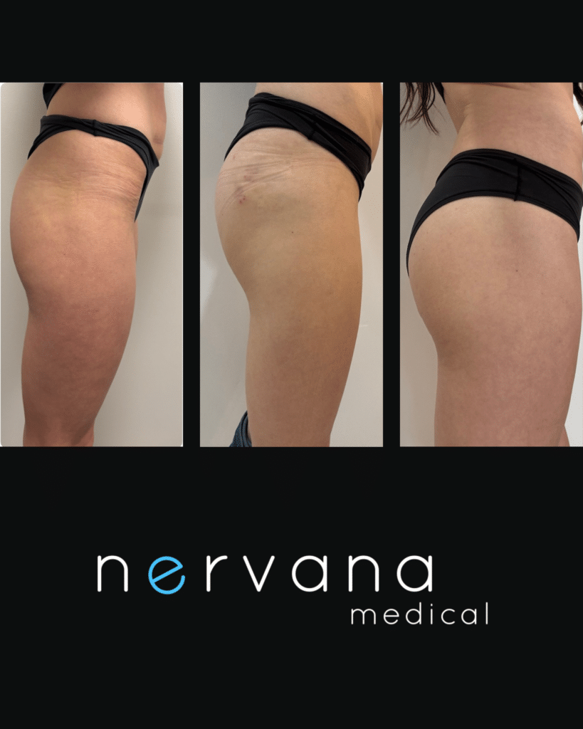 Sculptra® Butt Lift in Sandy, UT