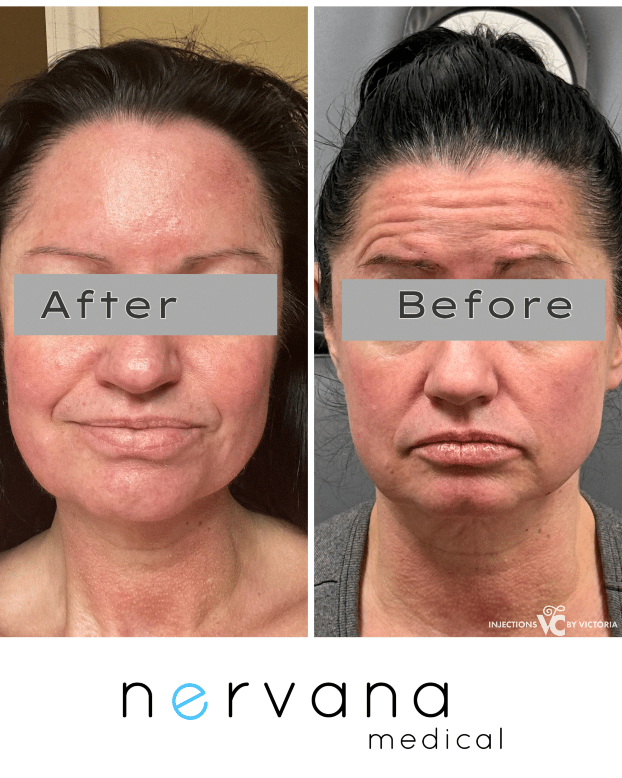 Before and After Image: Forehead Tox - front