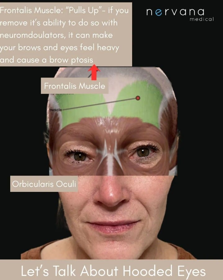 hooded eyes Forehead Botox and Hooded Eyes: What Every Sandy, UT Patient Should Know Before Treatment