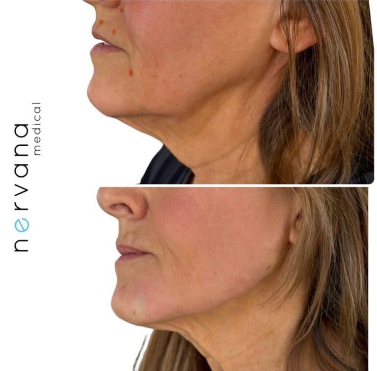 Before and After Image: Jawline - left-side