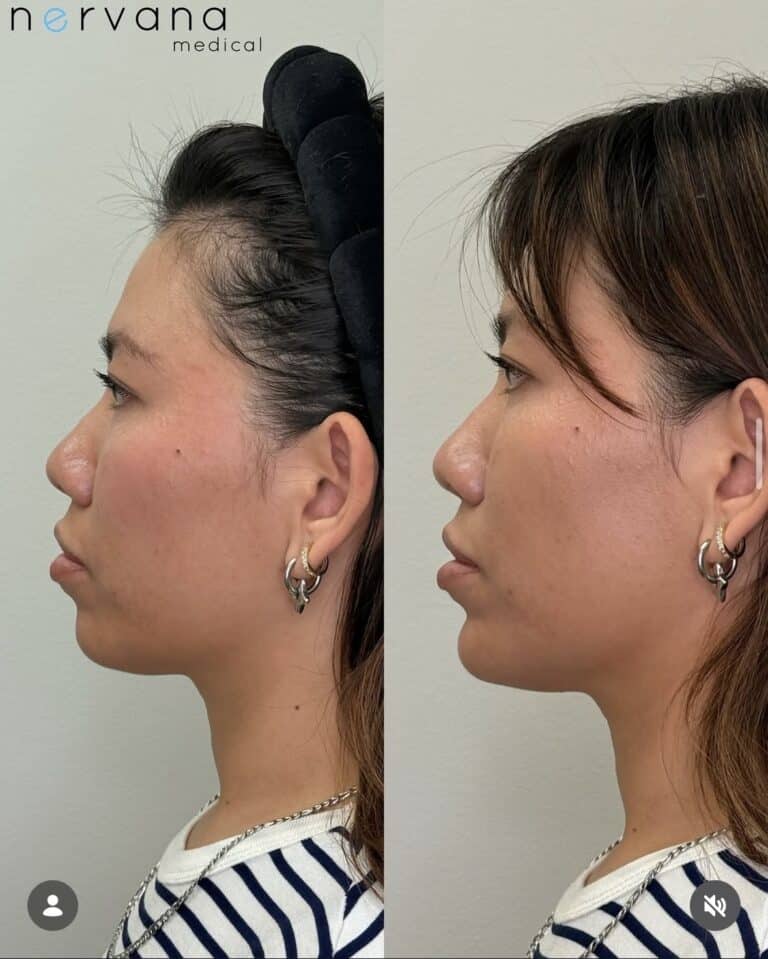 Before and After Image: Jawline - left-side
