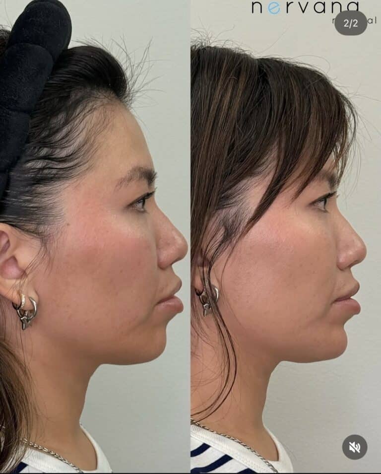 Before and After Image: Jawline - right-side