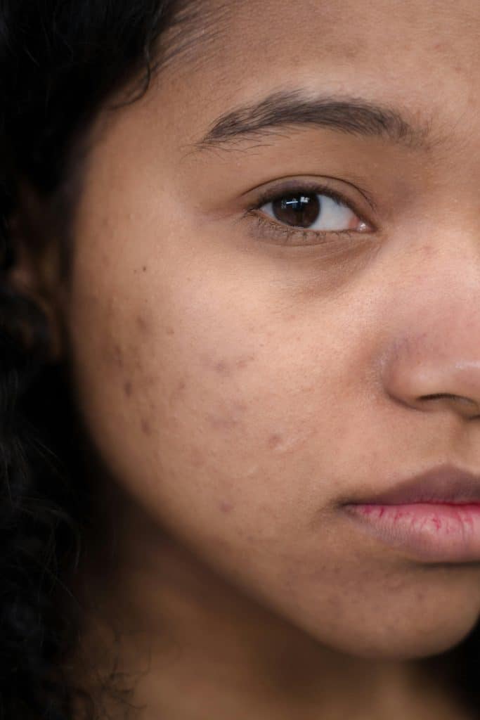 pexels-photo-9253774-9253774 Close-up shot focusing on natural skin and acne scars, showcasing authenticity and real beauty.