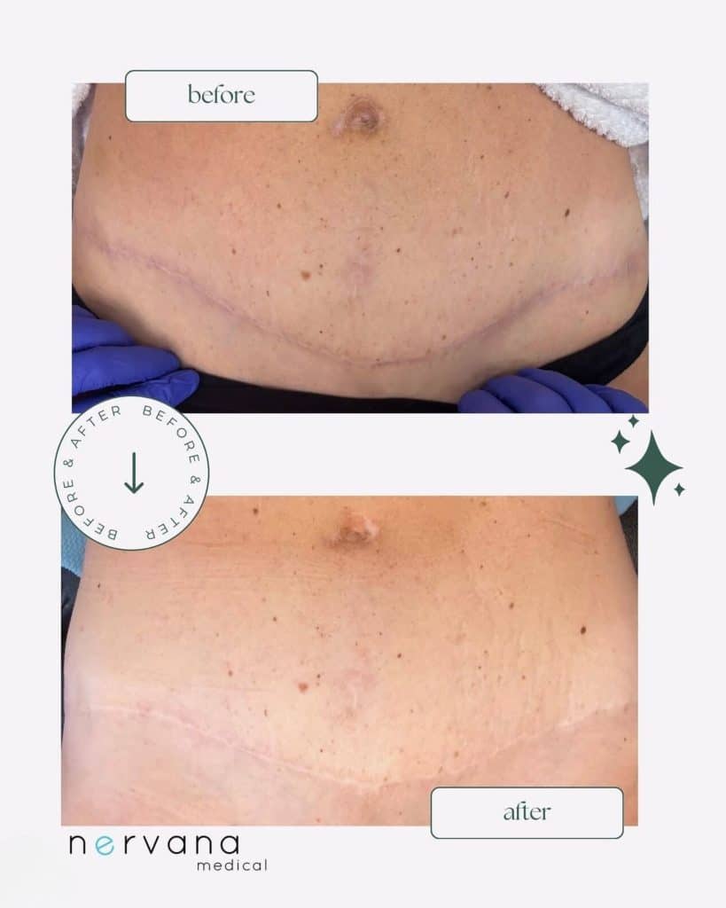 Before and After Image: Morpheus 8 Scar Treatments - front