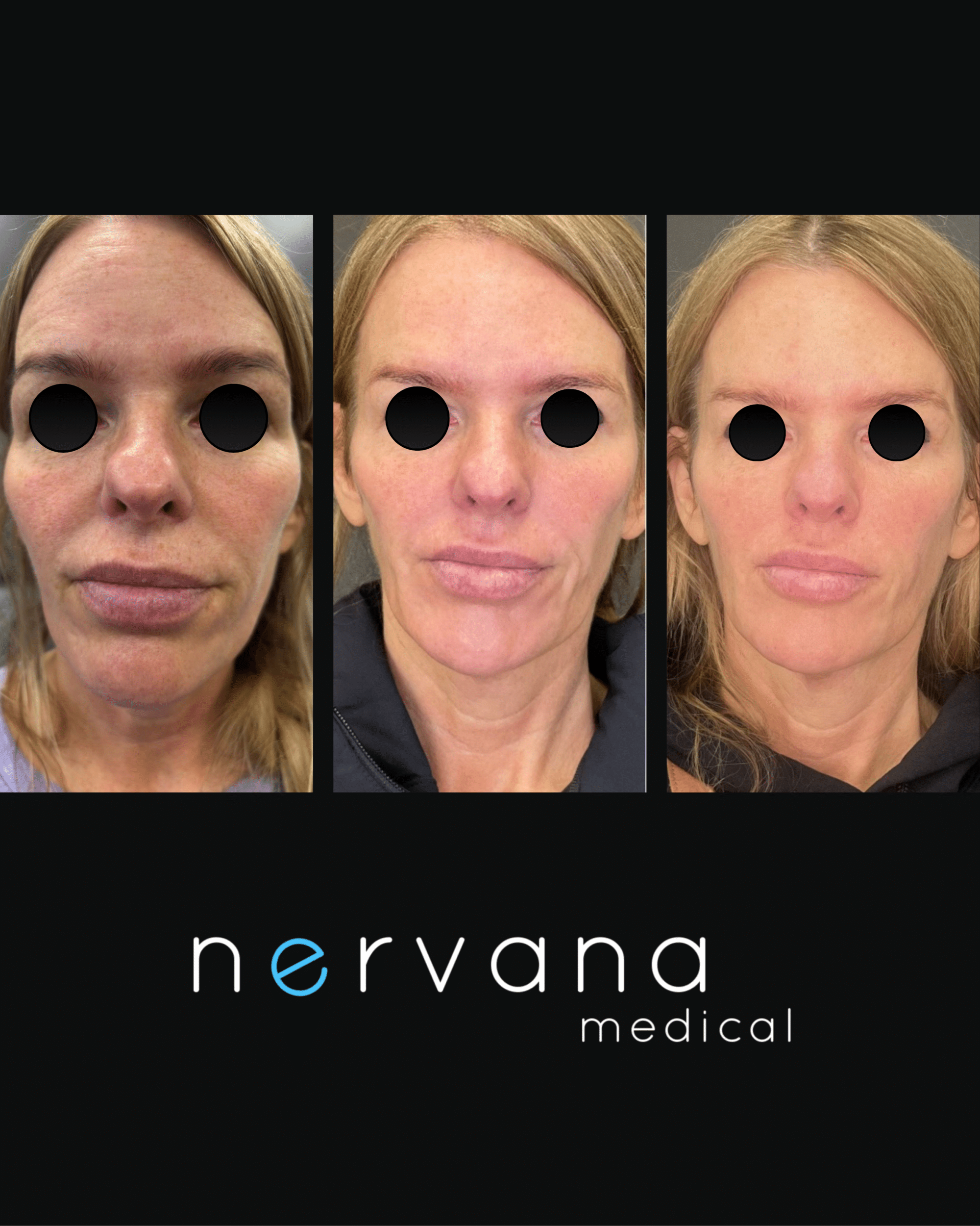 Before and After Image: Sculptra - front