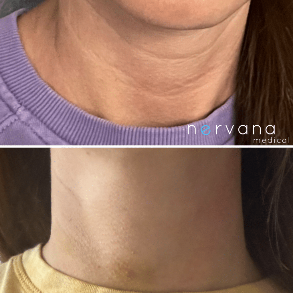 Before and After Image: Non Surgical Neck Lift + Morpheus - front