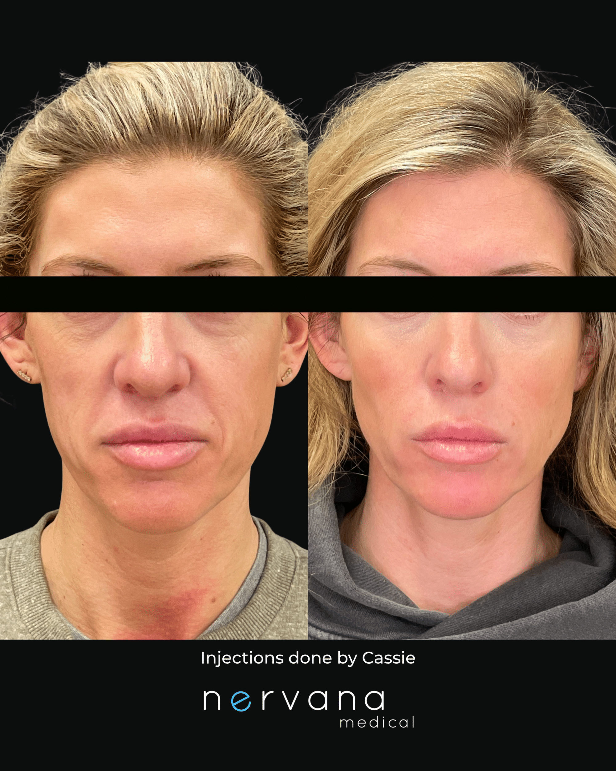 Before and After Image: Sculptra + HA - front