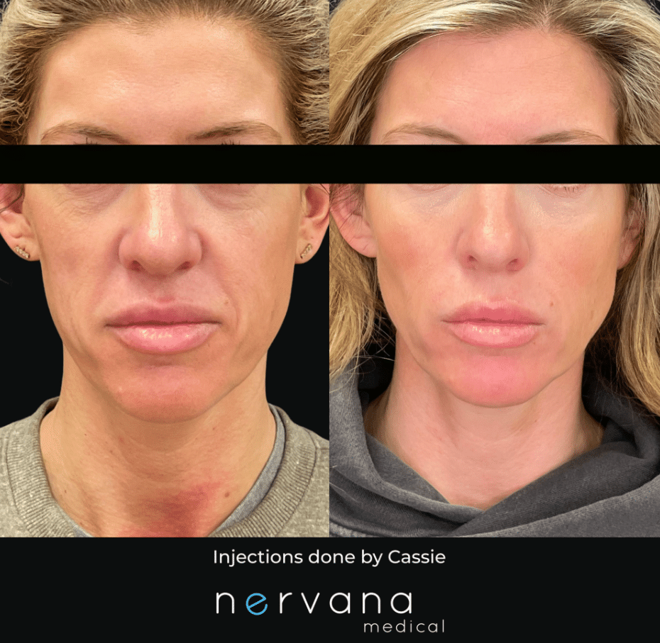 What Galderma's 9-Month "Ozempic Face" Study Tells Us, and How Our Sculpt and Lift Packages Are Built Around It