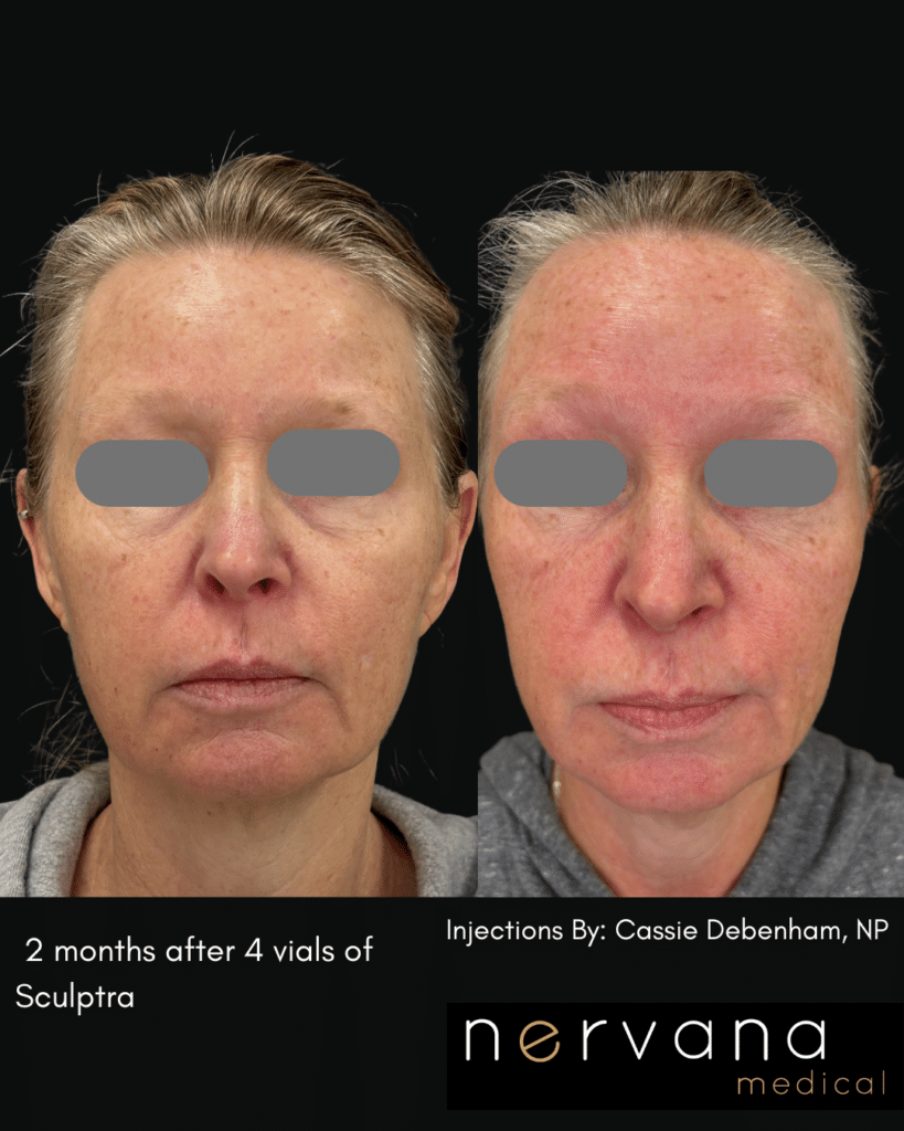 Before and After Image: Sculptra®Don’t Fill It. Rebuild It. - front
