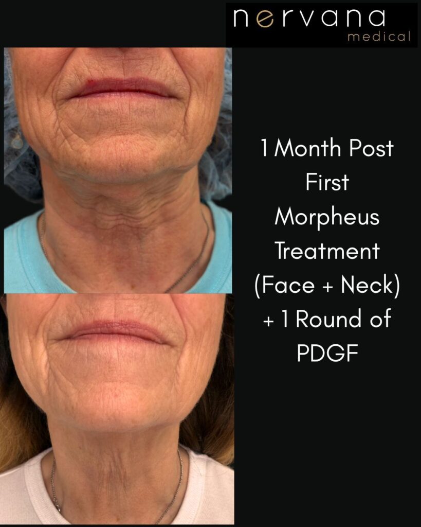 Before and After Image: RF Microneedling with Morpheus 8 + PDGF - front