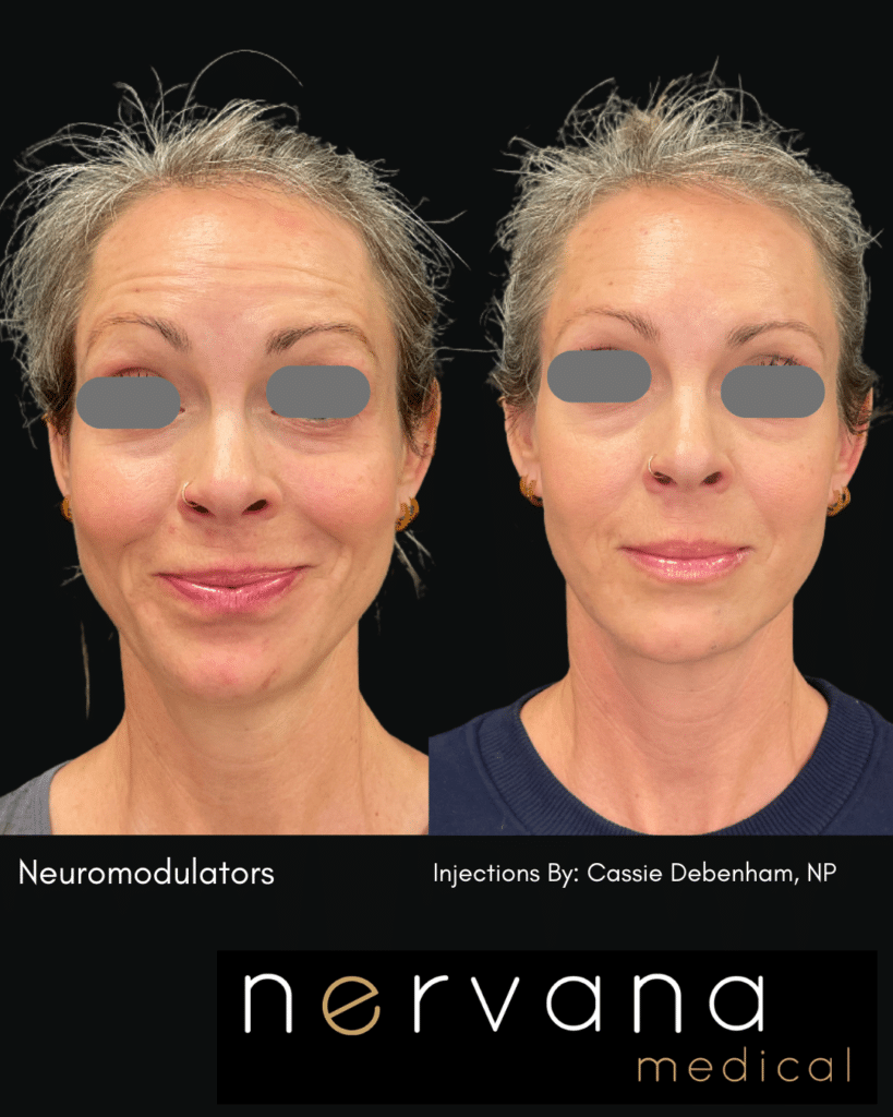 Before and After Image: FULL-FACE + NECK NEUROMODULATOR REJUVENATION - right-back-oblique