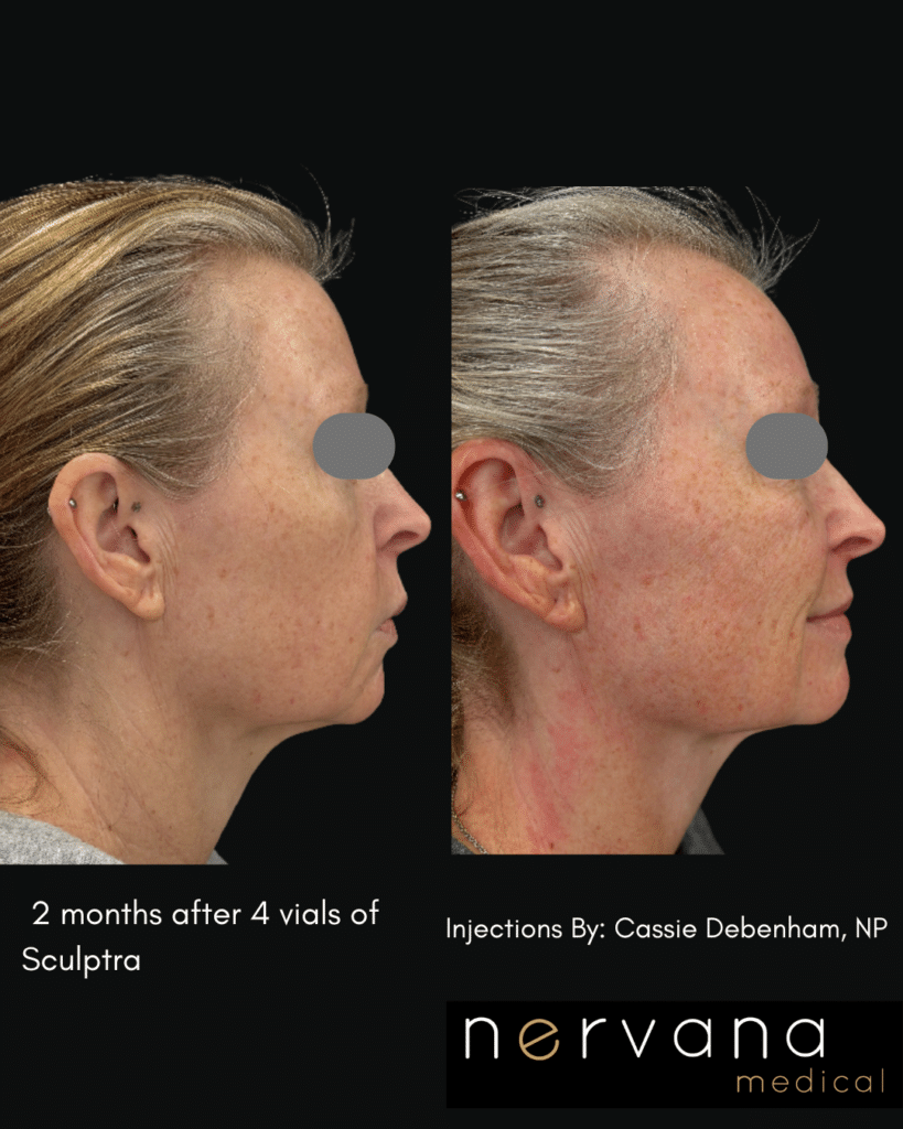 Before and After Image: Sculptra®Don’t Fill It. Rebuild It. - front