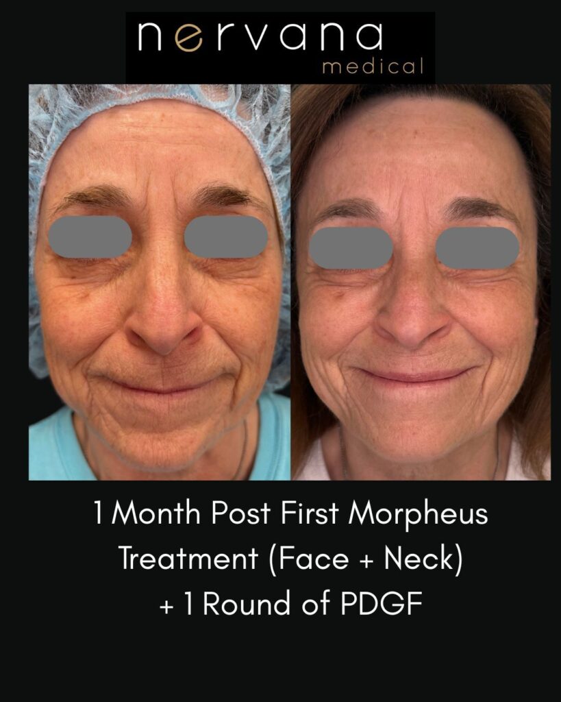 Before and After Image: RF Microneedling with Morpheus 8 + PDGF - front