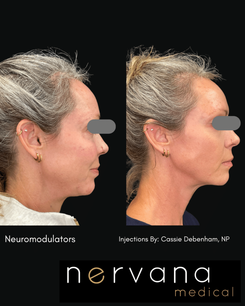 Before and After Image: FULL-FACE + NECK NEUROMODULATOR REJUVENATION - left-front-oblique