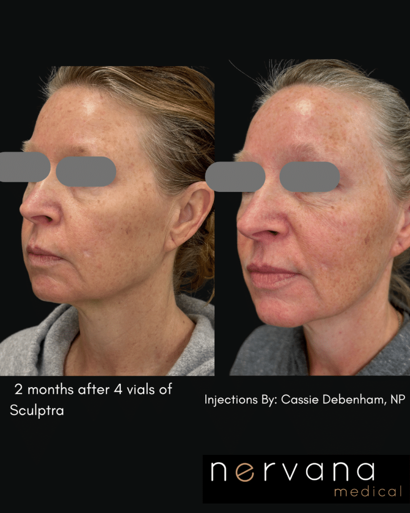 Before and After Image: Sculptra®Don’t Fill It. Rebuild It. - front