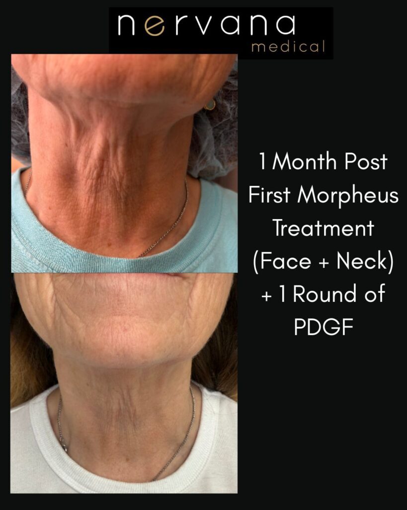 Before and After Image: RF Microneedling with Morpheus 8 + PDGF - right-front-oblique